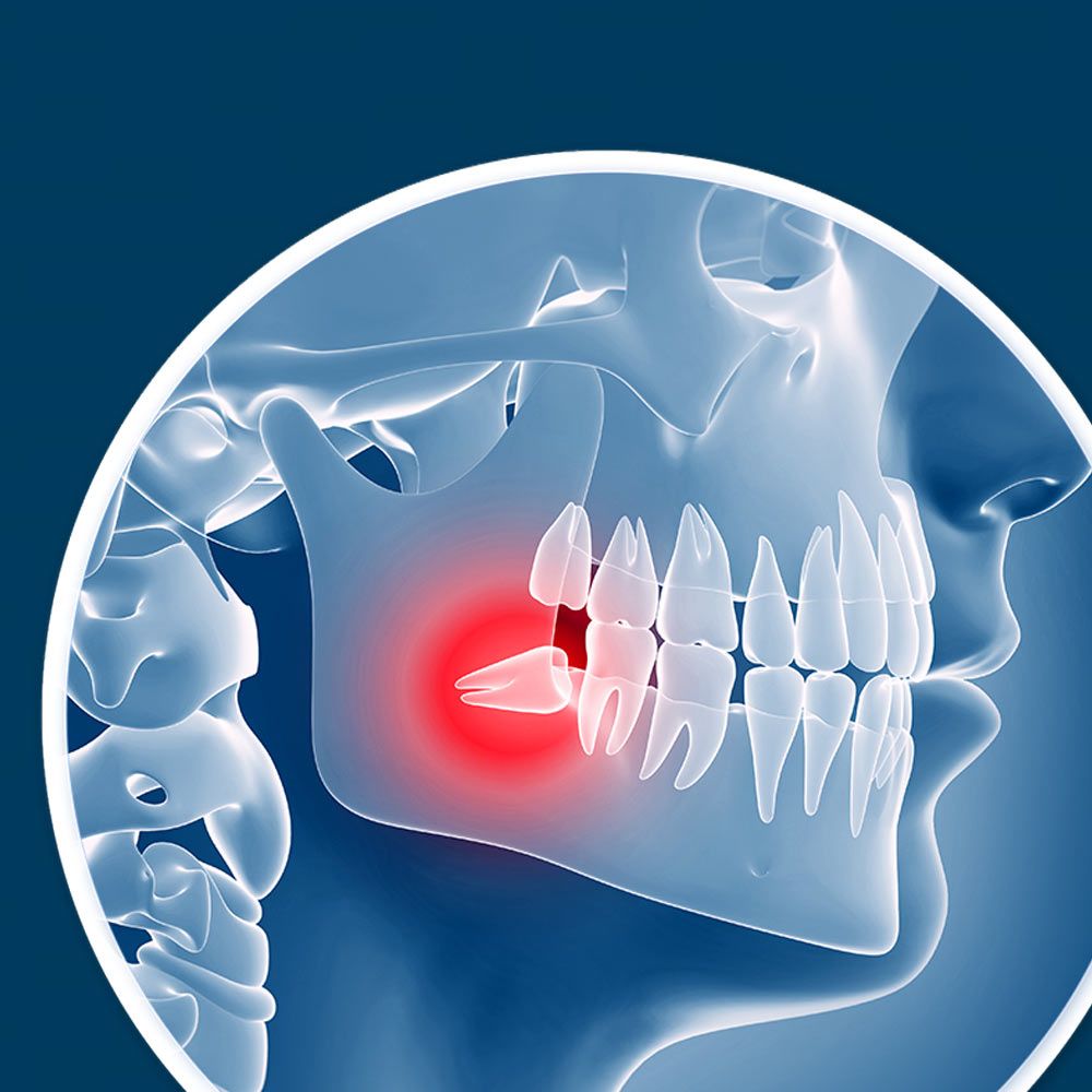 Tips for post-wisdom teeth removal